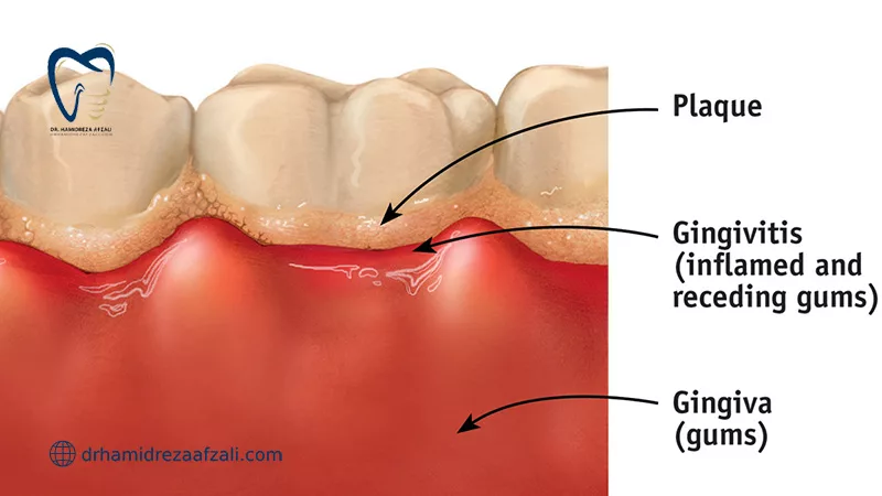 پلاک دندان و ژنژیویت