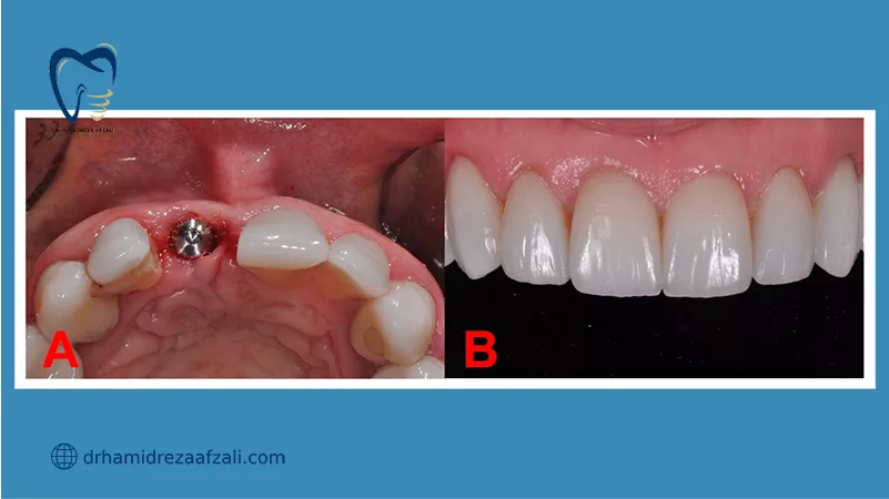 قبل و بعد از کاشت ایمپلنت دندان بدون جراحی