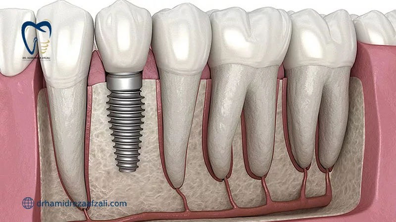 ماندگاری ایمپلنت