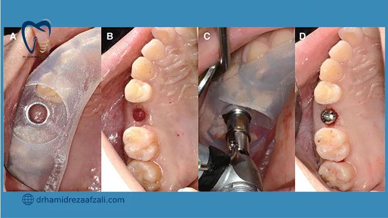 ایمپلنت دیجتال با سرجیکال گاید
