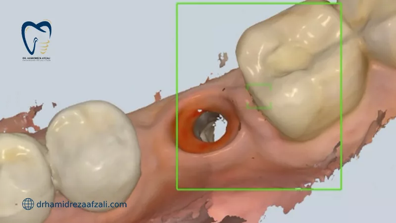 اسکن دیجیتال دندان