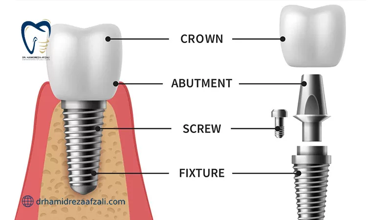 اجزای ایمپلنت دندان