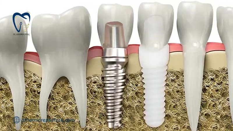 ایمپلنت تیتانیومی و زیرکونیومی در استخوان فک