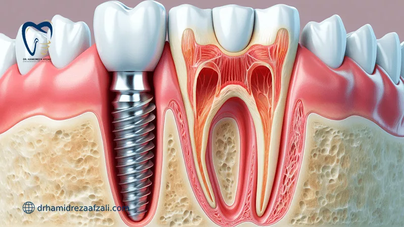 کاشت موفق ایمپلنت دندان