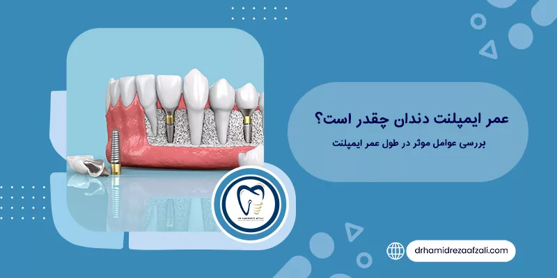 عمر ايمپلنت دندان چقدر است؟ بررسی عوامل موثر در طول عمر ایمپلنت