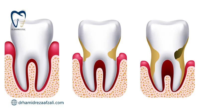 تجمع پلاک دندان، التهاب و تحلیل لثه