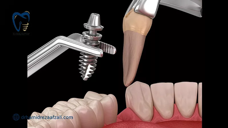 کشیدن دندان و ایمپلنت فوری