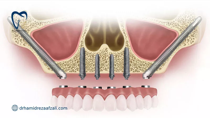 ایمپلنت زیگوماتیک در کنار ایمپلنت معمولی